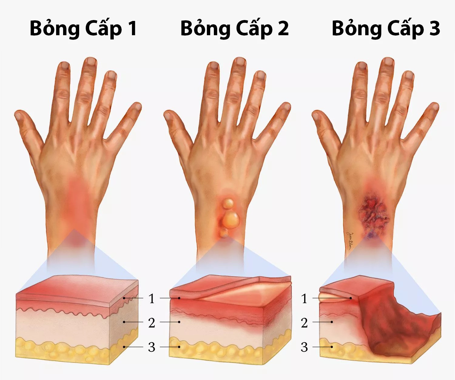 Các mức độ bỏng thường gặp